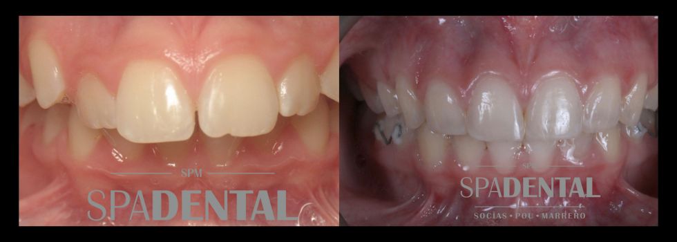 Tratamiento Ortodontico en adolescentes 2