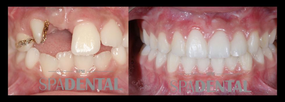 Tratamiento Ortodontico en adolescentes 3