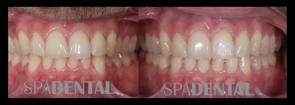 Tratamiento ortodoncia invisible (Invisalign)