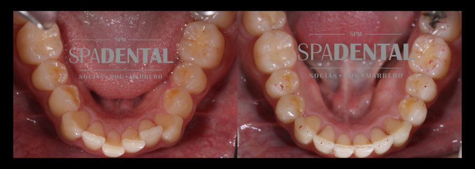 Tratamiento ortodoncia invisible (Invisalign) 2